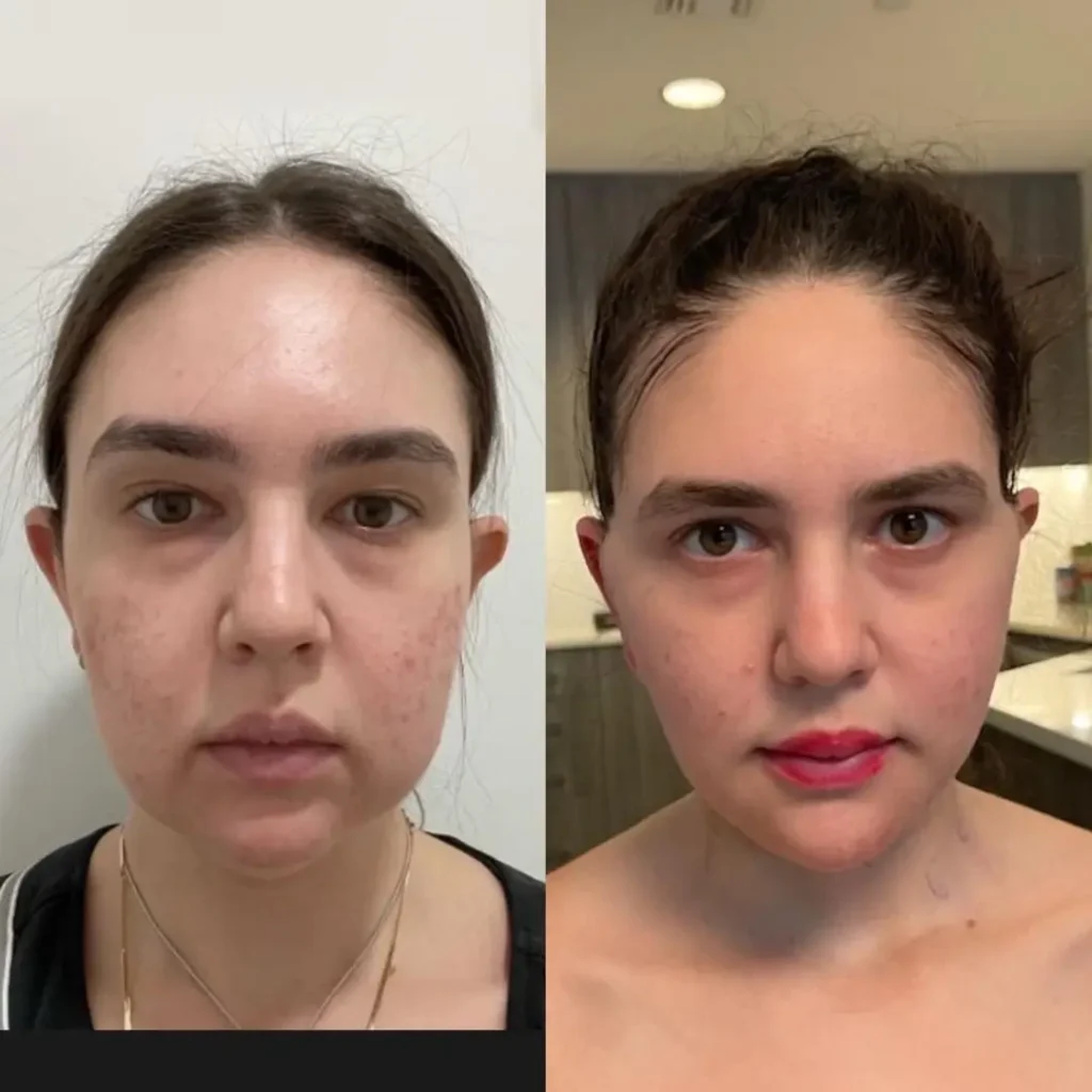 Before and after image of a female buccal fat removal